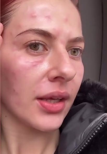 Lidia Buble și-a pus fanii pe jar! A apărut cu fața inflamată și amorțită, dar reacția ei i-a uimit pe toți: