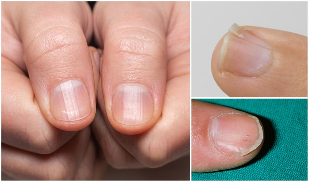Ai aceste semne pe unghii? Ar putea fi un mesaj clar despre sănătatea ta! Vezi explicația: