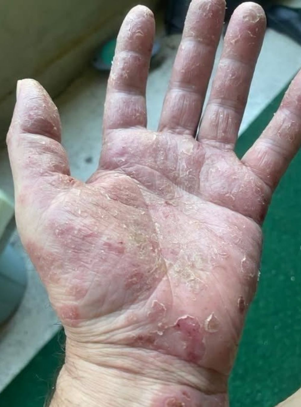 Atenție la aceste simptome! Pot anunța apariția unei afecțiuni inflamatorii rare
