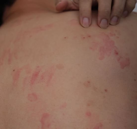 Mare atenție la aceste semne care pot apărea pe piele. Mâncărimea este adesea primul simptom pe care nu ar trebui să îl ignori